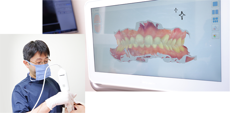 3D口腔内スキャナーによる歯型の採得